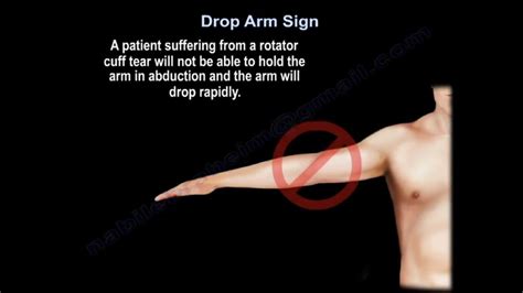 drop arm rotator cuff test|positive drop arm sign.